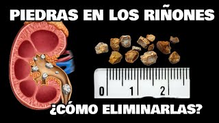 💥 PIEDRAS en LOS RIÑONES | ¿CÓMO ELIMINARLAS? ¿QUÉ SÍNTOMAS DAN?