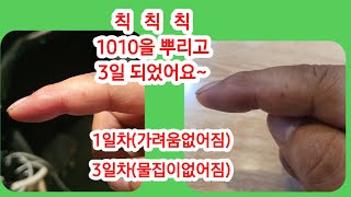 물집이 3일만에 없어지네요 칙칙칙비디펌 210906.