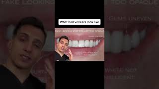 What does bad veneers look like?