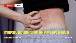 Marbled Skin Rash After a Dive