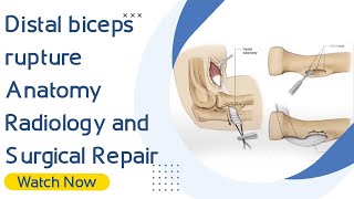 Distal biceps rupture | Anatomy ,Radiology and Surgical Repair