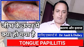 जीभ के ऊपर ये क्या हो गया है, कैसे ठीक करें। TONGUE PAPILLITIS। Dr Amit k Dubey