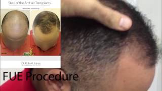 FUE Hair Transplant - 3000 Grafts - Dr. Rob Jones - Toronto CA Hair Transplant Doctor