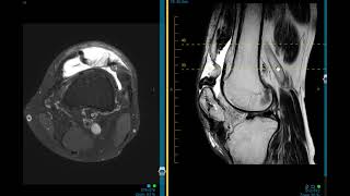 Quadriceps tendon re-tear