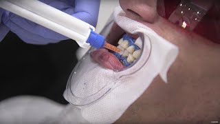 Can Tooth Whitening Hurt Your Teeth? | Earth Science