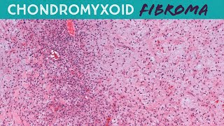 Chondromyxoid Fibroma CMF - Bone Pathology Basics (Yale case 8)