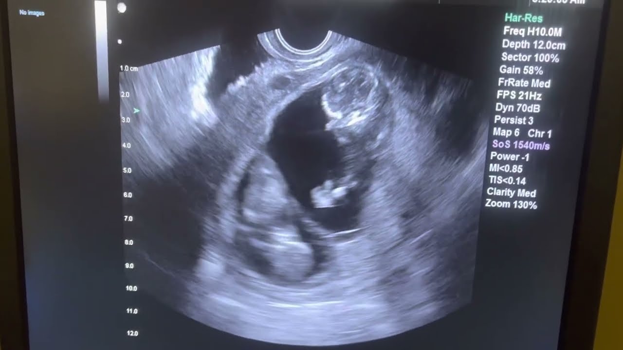 Twins At 12 Weeks Gestation! - YouTube