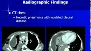 Complicated Pneumonia with Empyema in a Child