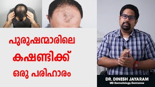 കഷണ്ടിക്ക് ഒരു പരിഹാരം | Medical management for male pattern baldness | Health Tips Malayalam