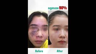 លុបស្នាមដៅពីកំណើត #laserremoval #lasertreatment #lasertattooremoval #laser #skincare