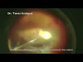 Severe PVR Repair in a Globe Rupture Case by Tansu Erakgun, Turkey