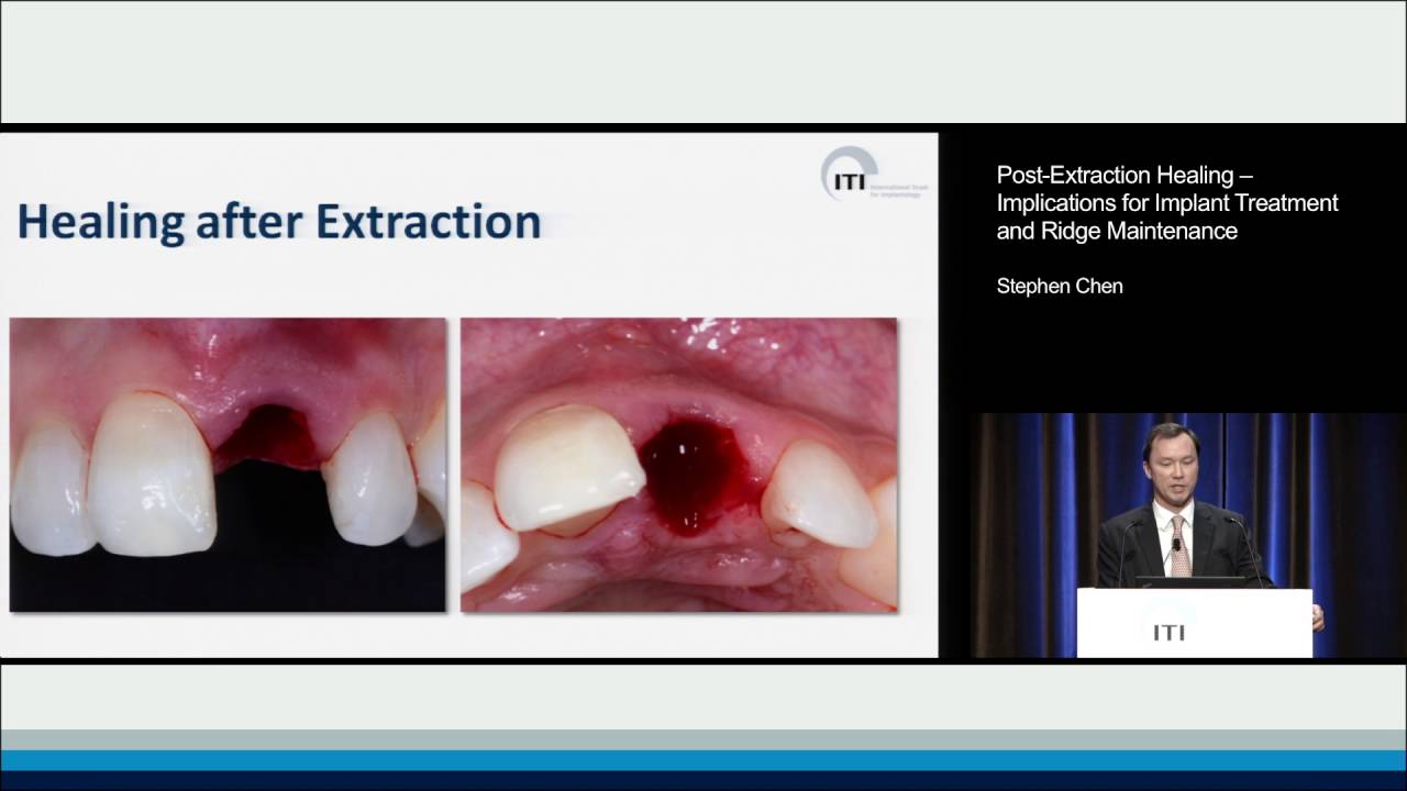Normal Healing After Tooth Extraction Tooth Extraction Healing