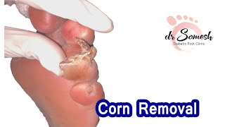 #corn Removal #toe