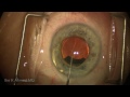 use of iris prosthesis for post cataract surgery iris transillumination defects