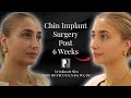 Inside a chin implant surgery - Dr. Julian De Silva