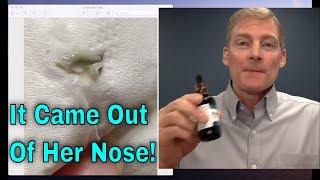 Horrific and Amazing! Parasites Coming out of Nose!