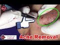 Removal Blackheads On The Face Easy│How To Remove Blackheads Easy | Acne Treatment Vlogs #5