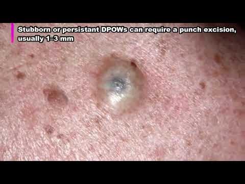 Dilated Pores Of Winer - YouTube