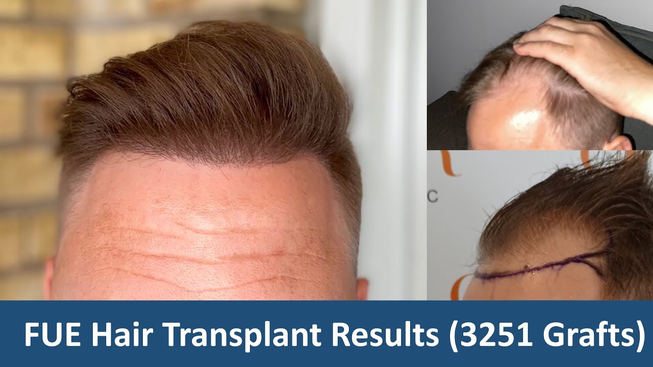 FUE Hair Transplant Results 3251 Grafts | 10.5 Months Update | Dr ...