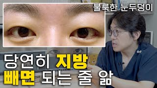 자기 눈두덩이가  눈지방이 많을 때 쌍꺼풀 수술 방법