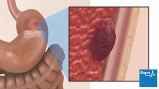 How a peptic ulcer develops