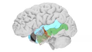 Animation of Human Brain Mapping With Multithousand-Channel Sensor Grids