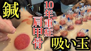 Cupping therapy tokyo You can do it by US EURO coin therapy