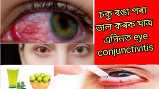 চকু ৰঙা পৰিলে কি কৰিব লাগে। eye conjunctivitis কেনেকৈ বাছি থাকিব পাৰি।