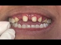 Houston Cosmetic Dentist...Gaps, missing teeth and an open bite...Watch this makeover!