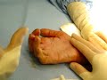 needle release operation of dupuytren contracture