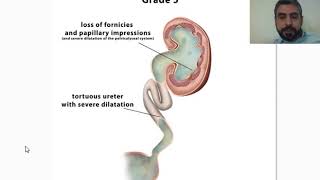 vesicoureteric reflux