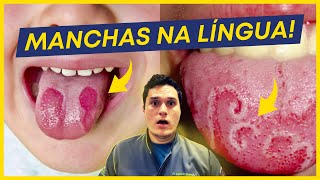 LÍNGUA BRANCA com MANCHAS VERMELHAS: O que pode ser?