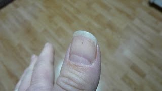 Black Lines Under Finger Nail - Horsehair Nematomorpha Parasite - Morgellons - Thread - Hook Worm