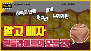 울퉁불퉁 셀룰라이트의 원인 대분석- 닥터스키니 최보윤원장  |  #cellulite #다이어트 |