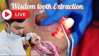 Wisdom tooth Extraction #pawar #dentist #video