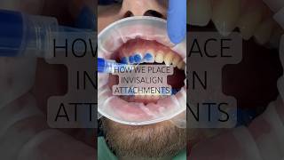 How we place Invisalign attachments or ‘buttons’… 🙌 #invisalign #newsmile #viral