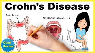 Crohn's disease: Symptoms, pathophysiology, diagnosis, treatment, mnemonic (Quick review)