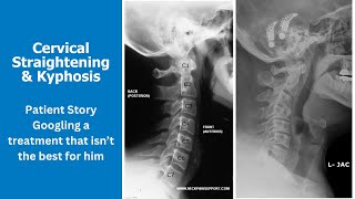 Straightening of the Cervical Spine   Best Treatments