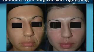 Radiofrequency Skin Tightening (Radiolift)