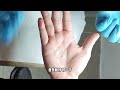 usually feet this time hands crazy removal of extra large palm warts