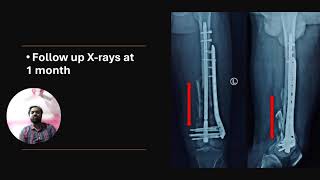 Distal femur communited fracture/ Nail with plate augmentation/ Patient success story