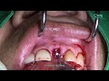 immediate implant placement u0026 minimally invasive horizontal ridge augmentation