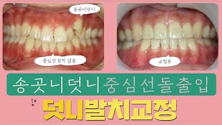 송곳니 덧니 중심선 맞지 않음 발치교정