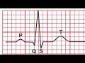 normal ekg vs. heart attack