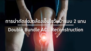 EP.4 การผ่าตัดส่องกล้องเอ็นไขว้หน้าฉีกขาดแบบสองแกน (Double Bundle ACL Reconstruction) #บำรุงราษฎร์