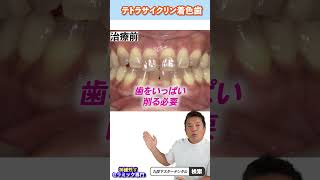 【テトラサイクリン着色歯】黒い歯・茶色い歯を白くするのに神経は取るな！【神経残すセラミック症例解説】　＃shorts