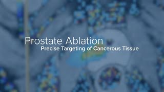 How Prostate Cancer is Treated With Ablation - Yale Medicine Explains