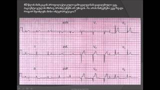 მიოკარდიუმის გადატანილი ინფარქტი /გულის იშემია / ფიზიკური დატვირთვის სინჯი (ტრედმილ ტესტი)