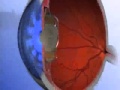 Multifocal Intraocular Lens: How Does It Work?