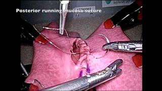 Laparoscopic Surgery - Gastrojejunostomy (Robotic Suturing)